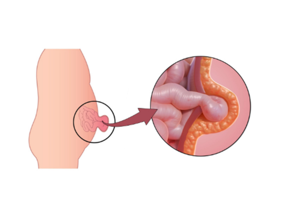 Expert Hernia Treatment in Delhi: Best Doctors & Hospitals Near You