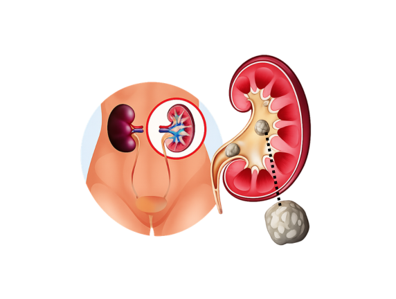 Kidney Stone Specialist Doctor in Ludhiana, Punjab | Safe Removal Guide