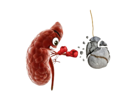 Cashless Kidney Stone Treatment in Delhi by Expert Urologists