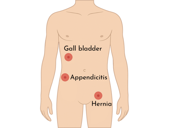 Top Surgeon in Delhi for Hernia, Gallbladder, Appendicitis & Piles