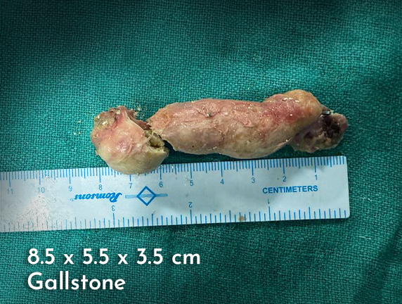 Successfully Treated Rare Giants Sized Gallbladder Condition in a 66-Year-Old Woman
