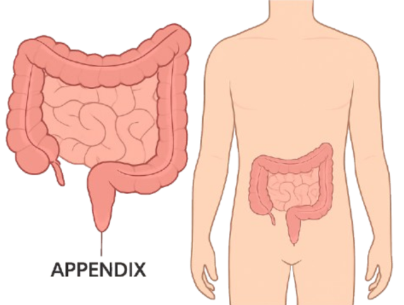 Appendix Treatment and Health Insurance Coverage in Delhi Hospitals