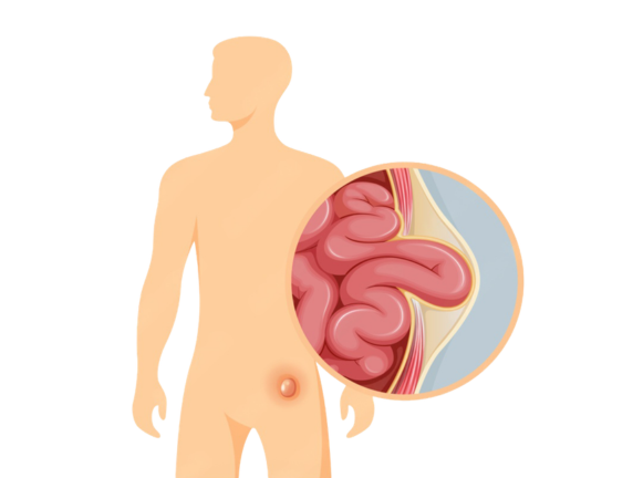 Hernia Treatment in Delhi: Early Signs, Symptoms, Costs & When to See a Doctor