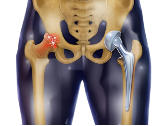 Hip Replacement Surgery in South Delhi: Best Hospitals, Surgeon, Cost & Recovery Guide