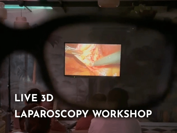 Live 3D Laparoscopy Cholecystectomy: The New Frontier in Laparoscopy