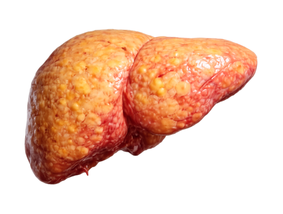 Fatty Liver Symptoms You Should Not Ignore
