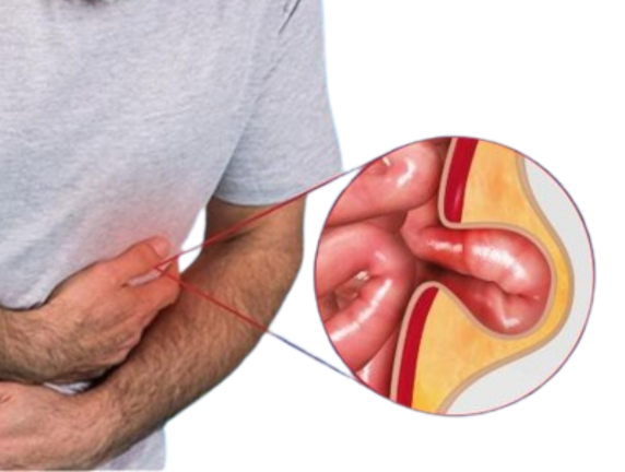 Hernia Treatment in Delhi: Best Doctors, Surgery Options & Cost Guide