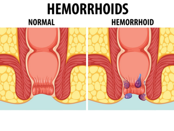 Internal vs. External Haemorrhoids: Differences Explained