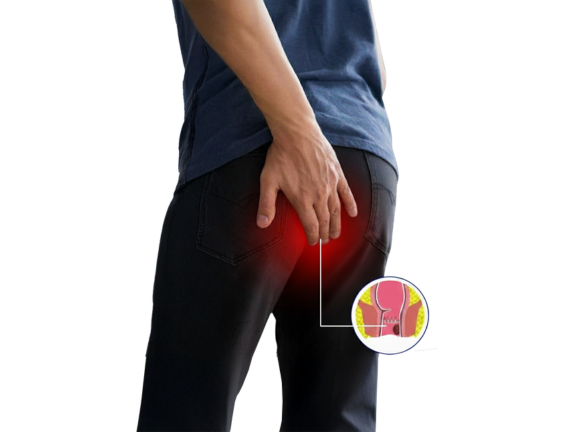 Fistula Treatment in Delhi: Causes, Symptoms & Latest Laser Surgery Options